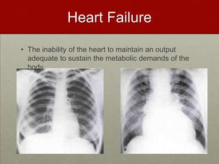 Heart FailureThe inability of the heart to maintain an output adequate to sustain the metabolic demands of the body