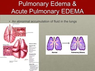 Pulmonary Edema & Acute Pulmonary EDEMAAn abnormal accumulation of fluid in the lungs