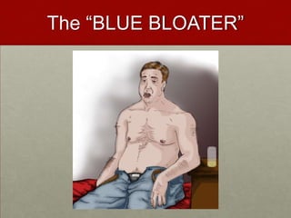 The “BLUE BLOATER”