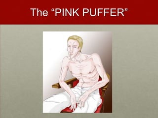 The “PINK PUFFER”