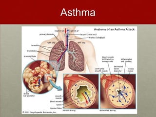 Asthma