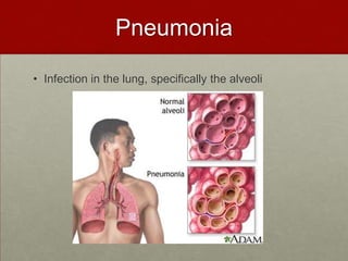 PneumoniaInfection in the lung, specifically the alveoli
