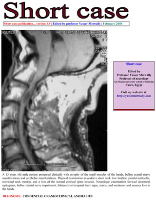 Short case publication... version 1.9 | Edited by professor Yasser Metwally | February 2008




                                                                                                        Short case

                                                                                                        Edited by
                                                                                                Professor Yasser Metwally
                                                                                                  Professor of neurology
                                                                                             Ain Shams university school of medicine
                                                                                                        Cairo, Egypt

                                                                                                   Visit my web site at:
                                                                                                http://yassermetwally.com




A 13 years old male patient presented clinically with atrophy of the small muscles of the hands, bulbar cranial nerve
manifestations and cerebellar manifestations. Physical examination revealed a short neck, low hairline, painful torticollis,
restricted neck motion, and a loss of the normal cervical spine lordosis. Neurologic examination showed downbeat
nystagmus, bulbar cranial nerve impairment, bilateral corticospinal tract signs, ataxia, and weakness and sensory loss in
the hands.

DIAGNOSIS: CONGENITAL CRANIOCERVICAL ANOMALIES
 