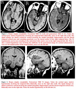 Short case...Herpes encephalitis