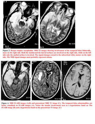 Short case...Herpes encephalitis