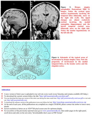 Short case...Herpes encephalitis