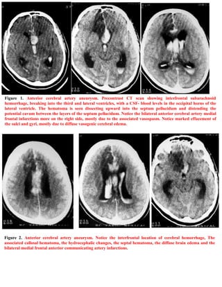 Short case...Ruptured anterior communicating aneurysm