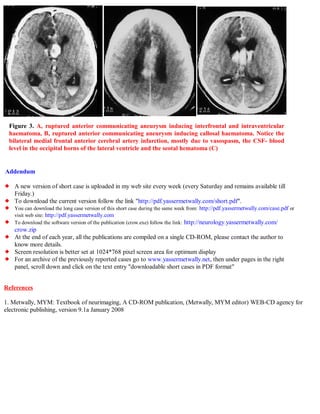 Short case...Ruptured anterior communicating aneurysm