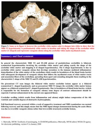 Short case...Postinfectious cerebellitis