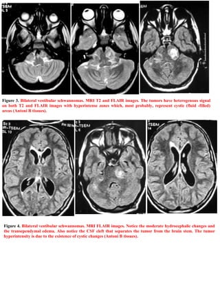 Short case...Neurofibromatosis type 2