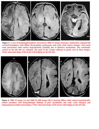 Shortcase...Hemimegalencephaly