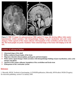 Shortcase...Hemimegalencephaly
