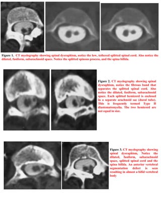Short case...Spinal dysraphism