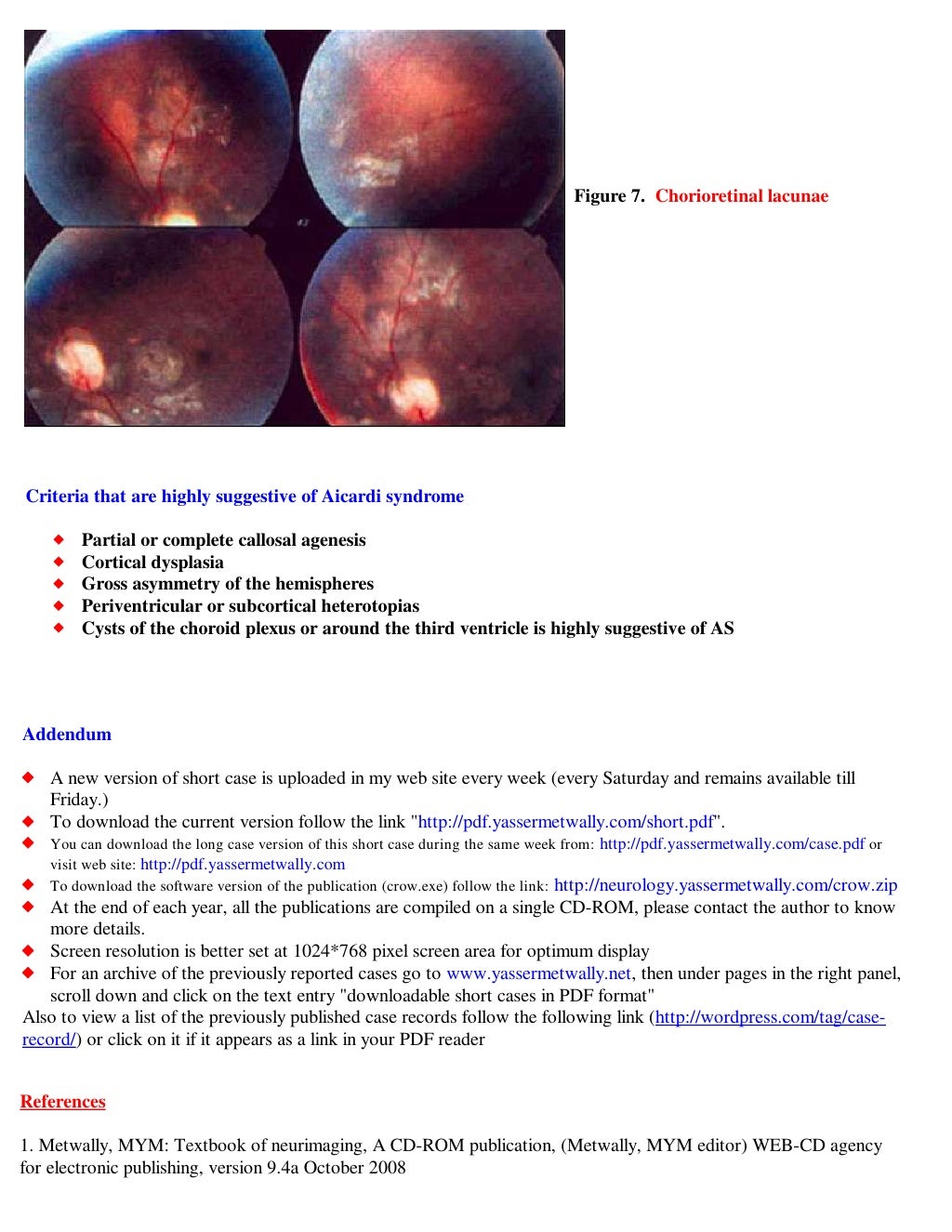 Short case&hellip;Aicardi syndrome
