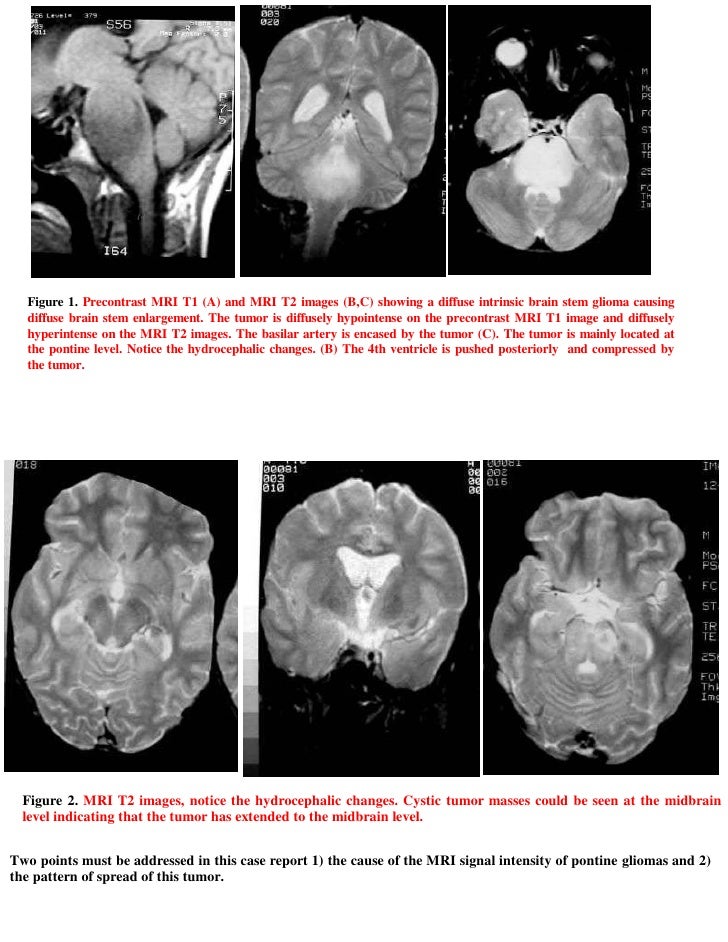 Short case...brain stem glioma