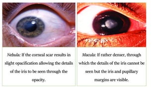 Nebula: If the corneal scar results in
slight opacification allowing the details
of the iris to be seen through the
opacity.
Macula: If rather denser, through
which the details of the iris cannot be
seen but the iris and pupillary
margins are visible.
 