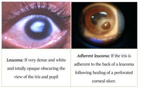 Leucoma: If very dense and white
and totally opaque obscuring the
view of the iris and pupil
Adherent leucoma: If the iris is
adherent to the back of a leucoma
following healing of a perforated
corneal ulcer.
 