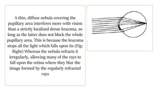 A thin, diffuse nebula covering the
pupillary area interferes more with vision
than a strictly localized dense leucoma, so
long as the latter does not block the whole
pupillary area. This is because the leucoma
stops all the light which falls upon its (Fig:
Right) Whereas the nebula refracts it
irregularly, allowing many of the rays to
fall upon the retina where they blur the
image formed by the regularly refracted
rays
 