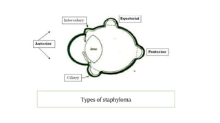 Types of staphyloma
 