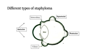 Different types of staphyloma
 