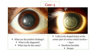 Case: 5
 What are the positive findings?
 What is the diagnosis?
 What may be the cause?
 A disc/coin shaped lesion at the
center part of cornea which involve--
-- layer
 Disciform keratitis
 Herpes
 