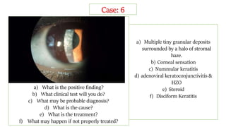 a) What is the positive finding?
b) What clinical test will you do?
c) What may be probable diagnosis?
d) What is the cause?
e) What is the treatment?
f) What may happen if not properly treated?
a) Multiple tiny granular deposits
surrounded by a halo of stromal
haze.
b) Corneal sensation
c) Nummular keratitis
d) adenoviral keratoconjunctivitis &
HZO
e) Steroid
f) Disciform Keratitis
Case: 6
 