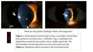 Figure 1. Demonstrates central Vogt's striae, or parallel, vertical lines
from posterior stromal stress. A Fleischer ring, or epithelial iron
deposition around the base of the cone is visible superiorly. The
horizontally-oriented opacities are areas of stromal scarring.
Figure 2. Significant apical scarring in the contralateral eye
What are the positive findings? What is the diagnosis?
CASE:8
 