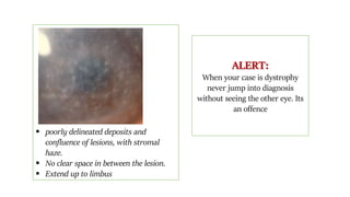  poorly delineated deposits and
confluence of lesions, with stromal
haze.
 No clear space in between the lesion.
 Extend up to limbus
ALERT:
When your case is dystrophy
never jump into diagnosis
without seeing the other eye. Its
an offence
 