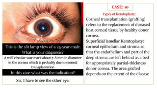This is the slit lamp view of a 25-year-male.
What is your diagnosis?
A well circular scar mark about 7-8 mm in diameter
in the cornea which is probably due to corneal
transplantation
In this case what was the indication?
Sir, I have to see the other eye.
Types of Keratoplasty:
Corneal transplantation (grafting)
refers to the replacement of diseased
host corneal tissue by healthy donor
cornea.
Superficial lamellar Keratoplasty:
corneal epithelium and stroma so
that the endothelium and part of the
deep stroma are left behind as a bed
for appropriately partial-thickness
donor cornea. The area grafted
depends on the extent of the disease
CASE: 10
 