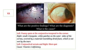 What are the positive findings? What are the diagnosis?
What is the cause?
Left: Foamy spots at the conjunctiva temporal to the cornea
Right: small, triangular, white patches on the outer sides of the
cornea, covered by a material resembling dried foam, which is not
wet by the tears
Left: Conjunctival xerosis and Right: Bitot spot
Cause: Vitamin A deficiency
12
 