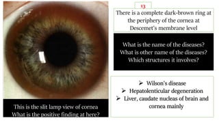This is the slit lamp view of cornea
What is the positive finding at here?
There is a complete dark-brown ring at
the periphery of the cornea at
Descemet’s membrane level
What is the name of the diseases?
What is other name of the diseases?
Which structures it involves?
 Wilson's disease
 Hepatolenticular degeneration
 Liver, caudate nucleas of brain and
cornea mainly
13
 