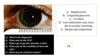 a) What is the diagnosis?
b) What may be the D/D?
c) What type of genetic disorder is this?
d) What may be the condition of lens and
why?
e) What may be refractive status?
a) Megalocornea
b) Congenital glaucoma
c) X-Linked
d) Lens subluxation may occur
due to zonular stretching
e) Myopia and astigmatism
14
 