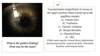 16
What is the positive finding?
What may be the cause?
Vascularization (superficial) of cornea at
the upper portion which extend up to the
pupillary margin
a) Contact lens
b) Trachoma
c) Chronic irritation
d) Herpes Keratitis
e) Chemical burn
f) VKC
(Other cause may be: corneal ulcers, phylctenular
keratoconjunctivitis, rosacea keratitis, interstitial
keratitis, sclerosing keratitis)
 