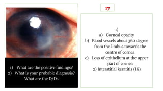 1) What are the positive findings?
2) What is your probable diagnosis?
What are the D/Ds
17
1)
a) Corneal opacity
b) Blood vessels about 360 degree
from the limbus towards the
centre of cornea
c) Loss of epithelium at the upper
part of cornea
2) Interstitial keratitis (IK)
 
