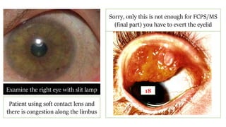 Examine the right eye with slit lamp
Patient using soft contact lens and
there is congestion along the limbus
Sorry, only this is not enough for FCPS/MS
(final part) you have to evert the eyelid
18
 