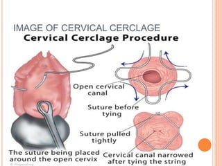 IMAGE OF CERVICAL CERCLAGE
 