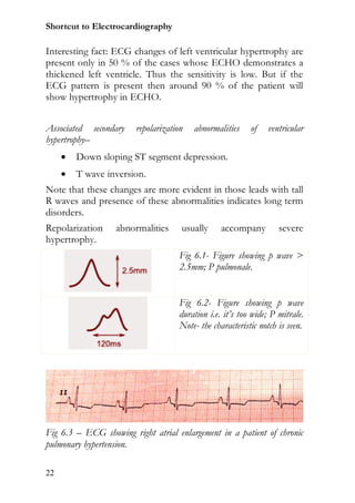 Shortcut to Electrocardiography

Interesting fact: ECG changes of left ventricular hypertrophy are
present only in 50 % of the cases whose ECHO demonstrates a
thickened left ventricle. Thus the sensitivity is low. But if the
ECG pattern is present then around 90 % of the patient will
show hypertrophy in ECHO.


Associated secondary    repolarization   abnormalities     of   ventricular
hypertrophy–
        Down sloping ST segment depression.
        T wave inversion.
Note that these changes are more evident in those leads with tall
R waves and presence of these abnormalities indicates long term
disorders.
Repolarization     abnormalities     usually      accompany         severe
hypertrophy.
                                     Fig 6.1- Figure showing p wave >
                                     2.5mm; P pulmonale.


                                     Fig 6.2- Figure showing p wave
                                     duration i.e. it’s too wide; P mitrale.
                                     Note- the characteristic notch is seen.




Fig 6.3 – ECG showing right atrial enlargement in a patient of chronic
pulmonary hypertension.

22
 