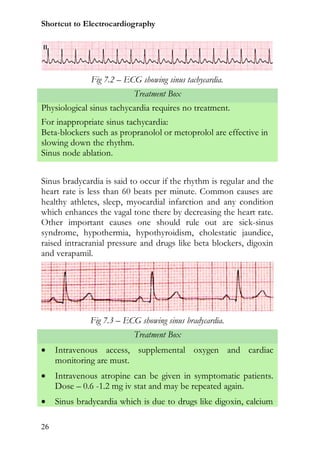Shortcut to Electrocardiography




               Fig 7.2 – ECG showing sinus tachycardia.
                           Treatment Box
Physiological sinus tachycardia requires no treatment.
For inappropriate sinus tachycardia:
Beta-blockers such as propranolol or metoprolol are effective in
slowing down the rhythm.
Sinus node ablation.


Sinus bradycardia is said to occur if the rhythm is regular and the
heart rate is less than 60 beats per minute. Common causes are
healthy athletes, sleep, myocardial infarction and any condition
which enhances the vagal tone there by decreasing the heart rate.
Other important causes one should rule out are sick-sinus
syndrome, hypothermia, hypothyroidism, cholestatic jaundice,
raised intracranial pressure and drugs like beta blockers, digoxin
and verapamil.




              Fig 7.3 – ECG showing sinus bradycardia.
                           Treatment Box
    Intravenous access, supplemental oxygen and cardiac
     monitoring are must.
    Intravenous atropine can be given in symptomatic patients.
     Dose – 0.6 -1.2 mg iv stat and may be repeated again.
    Sinus bradycardia which is due to drugs like digoxin, calcium

26
 
