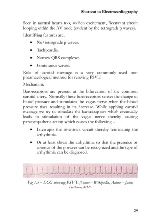 Shortcut to Electrocardiography

Seen in normal hearts too, sudden excitement, Reentrant circuit
looping within the AV node (evident by the retrograde p waves).
Identifying features are,
       No/retrograde p waves.
       Tachycardia.
       Narrow QRS complexes.
       Continuous waves.
Role of carotid message is a very commonly used non
pharmacological method for relieving PSVT.
Mechanism:
Baroreceptors are present at the bifurcation of the common
carotid artery. Normally these baroreceptors senses the change in
blood pressure and stimulates the vagus nerve when the blood
pressure rises resulting in its decrease. While applying carotid
message we try to stimulate the baroreceptors which eventually
leads to stimulation of the vagus nerve thereby causing
parasympathetic action which causes the following –
       Interrupts the re-entrant circuit thereby terminating the
        arrhythmia.
       Or at least slows the arrhythmia so that the presence or
        absence of the p waves can be recognized and the type of
        arrhythmia can be diagnosed.




  Fig 7.5 – ECG showing PSVT. [Source – Wikipedia, Author – James
                            Heilman, MD].




                                                                    29
 