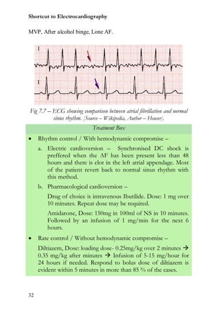 Shortcut to Electrocardiography

MVP, After alcohol binge, Lone AF.




Fig 7.7 – ECG showing comparison between atrial fibrillation and normal
          sinus rhythm. [Source – Wikipedia, Author – Heuser].
                            Treatment Box
    Rhythm control / With hemodynamic compromise –
     a. Electric cardioversion – Synchronised DC shock is
        preffered when the AF has been present less than 48
        hours and there is clot in the left atrial appendage. Most
        of the patient revert back to normal sinus rhythm with
        this method.
     b. Pharmacological cardioversion –
        Drug of choice is intravenous Ibutilide. Dose: 1 mg over
        10 minutes. Repeat dose may be required.
        Amidarone, Dose: 150mg in 100ml of NS in 10 minutes.
        Followed by an infusion of 1 mg/min for the next 6
        hours.
    Rate control / Without hemodynamic compromise –
     Diltiazem, Dose: loading dose- 0.25mg/kg over 2 minutes 
     0.35 mg/kg after minutes  Infusion of 5-15 mg/hour for
     24 hours if needed. Respond to bolus dose of diltiazem is
     evident within 5 minutes in more than 85 % of the cases.


32
 