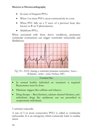 Shortcut to Electrocardiography

          In cases of frequent PVCs.
          When 3 or more PVCs occur consecutively in a row.
          When PVC falls on a T wave of a previous beat; also
           known as R on T phenomenon.
          Multiform PVCs.
When associated with these above conditions, premature
ventricular contractions can trigger ventricular tachycardia and
fibrillations.




     Fig 7.8 – ECG showing a ventricular premature contraction.[ Source –
                  Wikipedia, Author – James Heilman, MD].
                               Treatment Box
     In normal healthy individual no treatment is required.
      Reassurance must be done.
     Eliminate triggers like caffeine and tobacco.
     Drug therapy – Beta blockers, calcium channel blockers, anti-
      arrhythmic drugs like amidarone can use prescribed in
      symptomatic individuals.


Ventricular tachycardia
A run of 3 or more consecutive PVCs is called as ventricular
tachycardia. It is an emergency which commonly leads to cardiac
arrest.

34
 