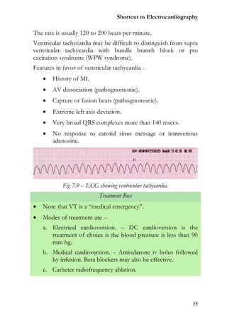 Shortcut to Electrocardiography

The rate is usually 120 to 200 beats per minute.
Ventricular tachycardia may be difficult to distinguish from supra
ventricular tachycardia with bundle branch block or pre
excitation syndrome (WPW syndrome).
Features in favor of ventricular tachycardia -
       History of MI.
       AV dissociation (pathognomonic).
       Capture or fusion beats (pathognomonic).
       Extreme left axis deviation.
       Very broad QRS complexes more than 140 msecs.
       No response to carotid sinus message or intravenous
        adenosine.




            Fig 7.9 – ECG showing ventricular tachycardia.
                           Treatment Box
   Note that VT is a “medical emergency”.
   Modes of treatment are –
    a. Electrical cardioversion. – DC cardioversion is the
       treatment of choice is the blood pressure is less than 90
       mm hg.
    b. Medical cardioversion. – Amiodarone iv bolus followed
       by infusion. Beta blockers may also be effective.
    c. Catheter radiofrequency ablation.




                                                               35
 
