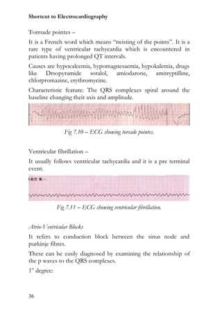 Shortcut to Electrocardiography

Torrsade pointes –
It is a French word which means “twisting of the points”. It is a
rare type of ventricular tachycardia which is encountered in
patients having prolonged QT intervals.
Causes are hypocalcemia, hypomagnesaemia, hypokalemia, drugs
like Drsopyramide sotalol, amiodarone, amitryptilline,
chlorpromazine, erythromycine.
Characteristic feature: The QRS complexes spiral around the
baseline changing their axis and amplitude.




                 Fig 7.10 – ECG showing torsade pointes.


Ventricular fibrillation –
It usually follows ventricular tachycardia and it is a pre terminal
event.




              Fig 7.11 – ECG showing ventricular fibrillation.


Atrio-Ventricular Blocks
It refers to conduction block between the sinus node and
purkinje fibres.
These can be easily diagnosed by examining the relationship of
the p waves to the QRS complexes.
1st degree:



36
 