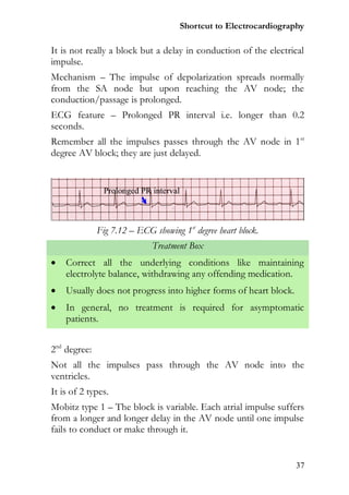 Shortcut to Electrocardiography

It is not really a block but a delay in conduction of the electrical
impulse.
Mechanism – The impulse of depolarization spreads normally
from the SA node but upon reaching the AV node; the
conduction/passage is prolonged.
ECG feature – Prolonged PR interval i.e. longer than 0.2
seconds.
Remember all the impulses passes through the AV node in 1 st
degree AV block; they are just delayed.




              Fig 7.12 – ECG showing 1st degree heart block.
                             Treatment Box
   Correct all the underlying conditions like maintaining
    electrolyte balance, withdrawing any offending medication.
   Usually does not progress into higher forms of heart block.
   In general, no treatment is required for asymptomatic
    patients.


2nd degree:
Not all the impulses pass through the AV node into the
ventricles.
It is of 2 types.
Mobitz type 1 – The block is variable. Each atrial impulse suffers
from a longer and longer delay in the AV node until one impulse
fails to conduct or make through it.


                                                                  37
 