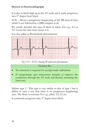 Shortcut to Electrocardiography

It is due to block high up in the AV node and it rarely progresses
into 3rd degree heart block.
ECG – Shows a progressive lengthening of the PR interval then
which is not followed by a QRS complex at all.
We usually describe this type of block in ratios. For e.g., 4:3 or
5:3. Lesser the ratio more severe it is.
It is also called as Wenckebach phenomenon.




          Fig 7.13 – ECG showing Wenckebach phenomenon.
                          Treatment Box
    No treatment is required for asymptomatic individuals.
    If symptomatic, give intravenous atropine to improve the
     conduction through the AV node and thereby increasing the
     heart rate.


Mobitz type 2 - This type is very similar to that of type 1 but it
differs in such a way that there is no progressive lengthening
seen. The block is constant. For e.g., either 3:2, 2:1 etc.
It commonly progresses into 3rd degree heart block.




38
 