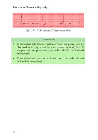 Shortcut to Electrocardiography




             Fig 7.15 – ECG showing 3rd degree heart block.


                            Treatment Box
    If associated with inferior wall infarction, the patient can be
     observed as it may revert back to normal sinus rhythm. If
     symptomatic or persistent, pacemaker should be inserted
     immediately.
    If associated with anterior wall infarction, pacemaker should
     be installed immediately.




40
 