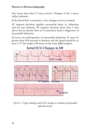 Shortcut to Electrocardiography

Few hours later these T waves inverts. Changes of the t waves
reflect ischemia.
If the blood flow is restored, t wave changes revert to normal.
ST segment elevation signifies myocardial injury i.e. infarction
and not just ischemia. ST segment elevation more than 1 mm
above the iso-electric lines in 2 consecutive leads is diagnostic of
myocardial infarction.
Q waves are pathognomic of myocardial infarction. It must be
greater than 0.04 seconds in duration and the depth should be at
least 1/3rd the height of R waves in the same QRS complex.




 Fig 8.3 – Figure showing serial ECG changes as evolution of myocardial
                            infarction occurs.




42
 