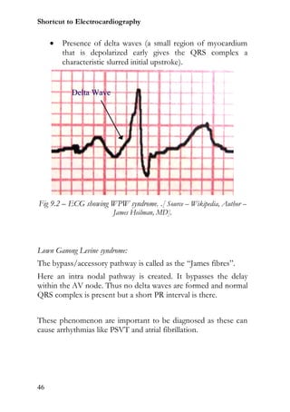 Shortcut to Electrocardiography

        Presence of delta waves (a small region of myocardium
         that is depolarized early gives the QRS complex a
         characteristic slurred initial upstroke).




Fig 9.2 – ECG showing WPW syndrome. .[ Source – Wikipedia, Author –
                        James Heilman, MD].




Lown Ganong Levine syndrome:
The bypass/accessory pathway is called as the “James fibres”.
Here an intra nodal pathway is created. It bypasses the delay
within the AV node. Thus no delta waves are formed and normal
QRS complex is present but a short PR interval is there.


These phenomenon are important to be diagnosed as these can
cause arrhythmias like PSVT and atrial fibrillation.




46
 