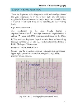 Shortcut to Electrocardiography

 Chapter 10. Bundle branch blocks.
These are diagnosed by looking at the width and configuration of
the QRS complexes. As we know these right and left bundles
supplies the depolarization wave to the respective ventricles, thus
it is easier to different these blocks according to the overlying
leads.
Right bundle branch block –
The conduction to the right bundle branch is
impaired/obstructed  Thus right ventricular depolarization is
delayed  Hence wide QRS complexes are formed on the ECG.
ECG – a unique diagnostic shape is seen in those leads overlying
the right ventricle i.e. V1 and V2. The typical complex formed is
RSR’/ M shaped / Rabbit ears.
Formulae- V1 (MORROW) V6.
Causes – may be present as a normal variant, in right ventricular
hypertrophy, pulmonary embolism, congenital (e.g. ASD),
coronary artery diseases.




          Fig 10.1 – ECG showing right bundle branch block.

                                                                47
 