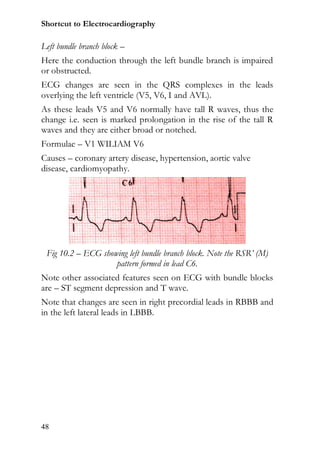 Shortcut to Electrocardiography

Left bundle branch block –
Here the conduction through the left bundle branch is impaired
or obstructed.
ECG changes are seen in the QRS complexes in the leads
overlying the left ventricle (V5, V6, I and AVL).
As these leads V5 and V6 normally have tall R waves, thus the
change i.e. seen is marked prolongation in the rise of the tall R
waves and they are either broad or notched.
Formulae – V1 WILIAM V6
Causes – coronary artery disease, hypertension, aortic valve
disease, cardiomyopathy.




 Fig 10.2 – ECG showing left bundle branch block. Note the RSR’ (M)
                    pattern formed in lead C6.
Note other associated features seen on ECG with bundle blocks
are – ST segment depression and T wave.
Note that changes are seen in right precordial leads in RBBB and
in the left lateral leads in LBBB.




48
 